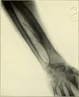 An illustration from Die Röntgenstrahlen im Dienste der Chirurgie (1902)
