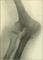 Picture 47 of 54 from Die Röntgenstrahlen im Dienste der Chirurgie (1902), leaf 236