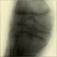 An illustration from Die Röntgenstrahlen im Dienste der Chirurgie (1902)
