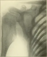 Picture 50 of 54 from Die Röntgenstrahlen im Dienste der Chirurgie (1902), leaf 244