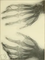 An illustration from Die Röntgenstrahlen im Dienste der Chirurgie (1902)