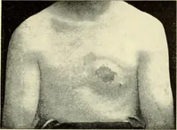 An illustration from Die Röntgenstrahlen im Dienste der Chirurgie (1902)