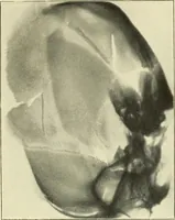 An illustration from Die Röntgenstrahlen im Dienste der Chirurgie (1902)