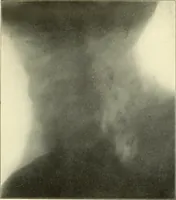 An illustration from Die Röntgenstrahlen im Dienste der Chirurgie (1902)