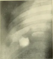 An illustration from Die Röntgenstrahlen im Dienste der Chirurgie (1902)