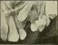 Picture 60 of 145 from Die Röntgentechnik : Lehrbuch für Ärzte und Studierende (1906), leaf 214
