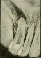 Picture 61 of 145 from Die Röntgentechnik : Lehrbuch für Ärzte und Studierende (1906), leaf 215