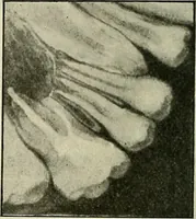 Picture 65 of 145 from Die Röntgentechnik : Lehrbuch für Ärzte und Studierende (1906), leaf 217