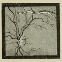 An illustration from Diseases of the eye. (1890)