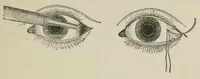 An illustration from Diseases of the eye. (1890)