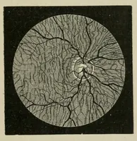Picture 5 of 18 from Diseases of the eye. (1890), leaf 75