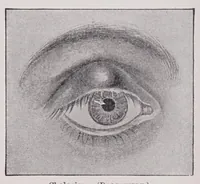 Picture 4 of 13 from Diseases of the eye (1900), leaf 96