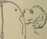 An illustration from Diseases of the stomach : a text-book for practitioners and students (1906)