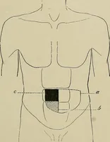 An illustration from Diseases of the stomach : a text-book for practitioners and students (1906)