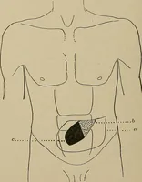 An illustration from Diseases of the stomach : a text-book for practitioners and students (1906)