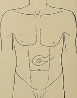 An illustration from Diseases of the stomach : a text-book for practitioners and students (1906)