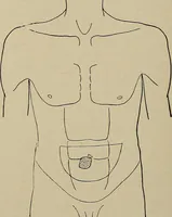 An illustration from Diseases of the stomach : a text-book for practitioners and students (1906)