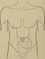 An illustration from Diseases of the stomach : a text-book for practitioners and students (1906)