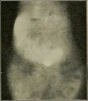 An illustration from Diseases of the stomach : a text-book for practitioners and students (1906)
