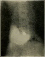 An illustration from Diseases of the stomach : a text-book for practitioners and students (1906)