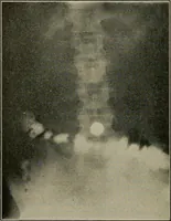 An illustration from Diseases of the stomach : a text-book for practitioners and students (1906)
