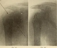 Picture 59 of 481 from Fractures and dislocations, diagnosis and treatment (1915), leaf 104