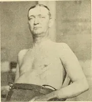 An illustration from Fractures and dislocations, diagnosis and treatment (1915)