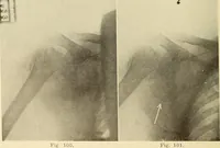 Picture 61 of 481 from Fractures and dislocations, diagnosis and treatment (1915), leaf 105
