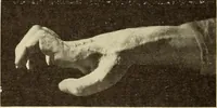 An illustration from Fractures and dislocations, diagnosis and treatment (1915)