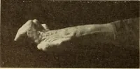 An illustration from Fractures and dislocations, diagnosis and treatment (1915)