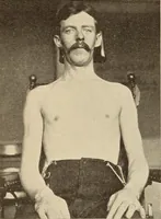 Picture 65 of 481 from Fractures and dislocations, diagnosis and treatment (1915), leaf 110