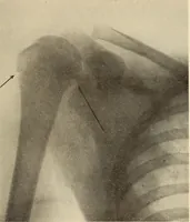 Picture 67 of 481 from Fractures and dislocations, diagnosis and treatment (1915), leaf 116