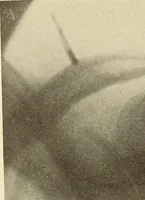 An illustration from Fractures and dislocations, diagnosis and treatment (1915)