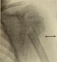 Picture 69 of 481 from Fractures and dislocations, diagnosis and treatment (1915), leaf 120