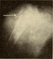 An illustration from Fractures and dislocations, diagnosis and treatment (1915)