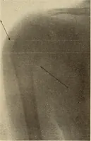 An illustration from Fractures and dislocations, diagnosis and treatment (1915)