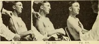 Picture 77 of 481 from Fractures and dislocations, diagnosis and treatment (1915), leaf 127