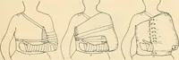 An illustration from Fractures and dislocations, diagnosis and treatment (1915)