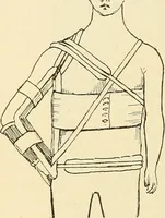 An illustration from Fractures and dislocations, diagnosis and treatment (1915)
