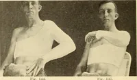 Picture 87 of 481 from Fractures and dislocations, diagnosis and treatment (1915), leaf 135