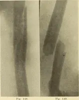 An illustration from Fractures and dislocations, diagnosis and treatment (1915)