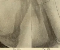 Picture 90 of 481 from Fractures and dislocations, diagnosis and treatment (1915), leaf 142