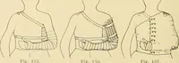 Picture 92 of 481 from Fractures and dislocations, diagnosis and treatment (1915), leaf 145