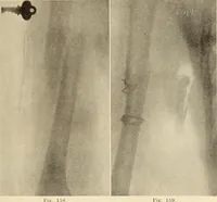 Picture 93 of 481 from Fractures and dislocations, diagnosis and treatment (1915), leaf 148