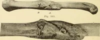 Picture 94 of 481 from Fractures and dislocations, diagnosis and treatment (1915), leaf 149