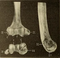 An illustration from Fractures and dislocations, diagnosis and treatment (1915)