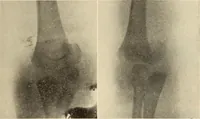 Picture 97 of 481 from Fractures and dislocations, diagnosis and treatment (1915), leaf 152