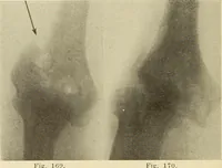 Picture 98 of 481 from Fractures and dislocations, diagnosis and treatment (1915), leaf 153