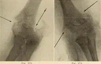 Picture 99 of 481 from Fractures and dislocations, diagnosis and treatment (1915), leaf 154