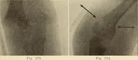 Picture 100 of 481 from Fractures and dislocations, diagnosis and treatment (1915), leaf 154
